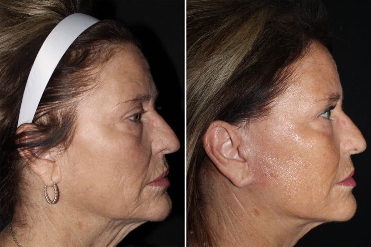 Mini Lift Before and After Photos in CA, Irvine, Patient 2819