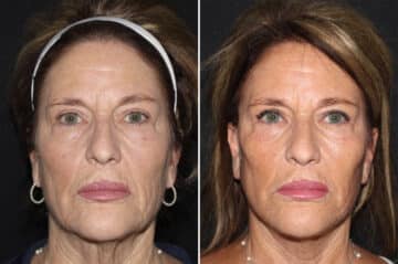 Mini Lift Before and After Photos in CA, Irvine, Patient 2819