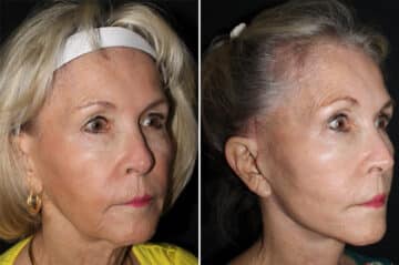 Mini Lift Before and After Photos in CA, Irvine, Patient 2841