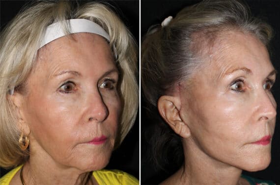 Mini Lift Before and After Photos in CA, Irvine, Patient 2841