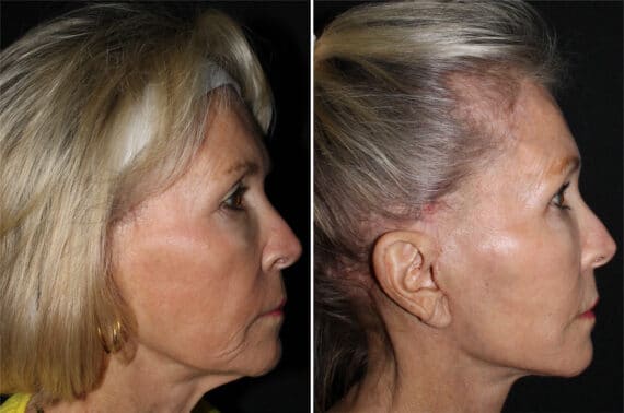 Mini Lift Before and After Photos in CA, Irvine, Patient 2841