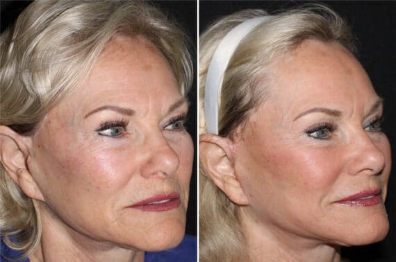 Mini Lift Before and After Photos in CA, Irvine, Patient 2845