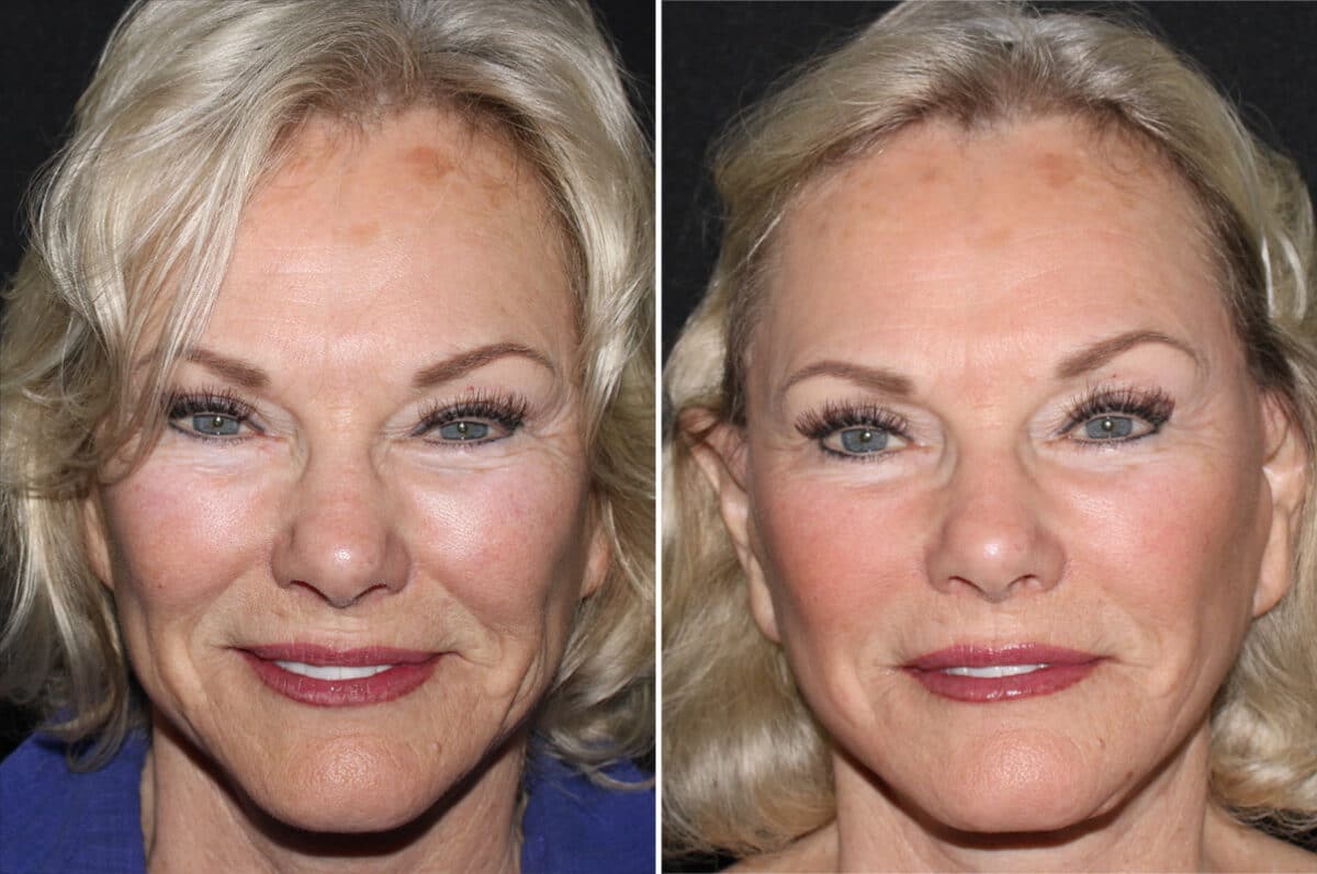 Mini Lift Before and After Photos in CA, Irvine, Patient 2845