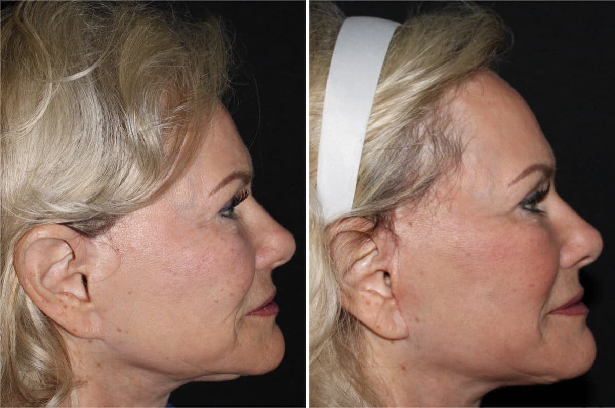 Mini Lift Before and After Photos in CA, Irvine, Patient 2845