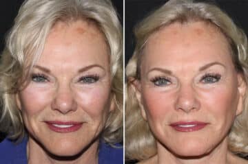 Mini Lift Before and After Photos in CA, Irvine, Patient 2845