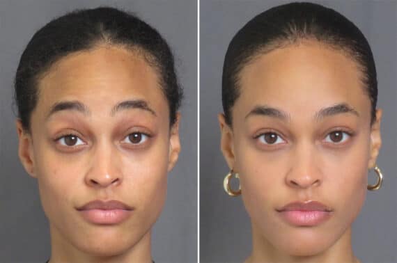 Botox / Dysport Before and After Photos in CA, Irvine, Patient 2855