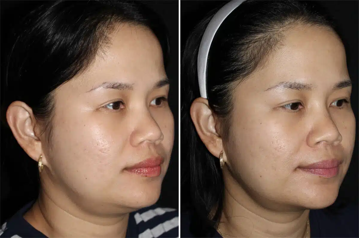 Double Chin Lipo Before and After Photos in CA, Irvine, Patient 2858