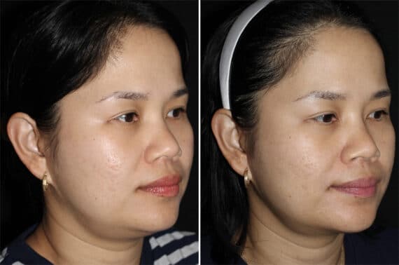 Double Chin Lipo Before and After Photos in CA, Irvine, Patient 2858