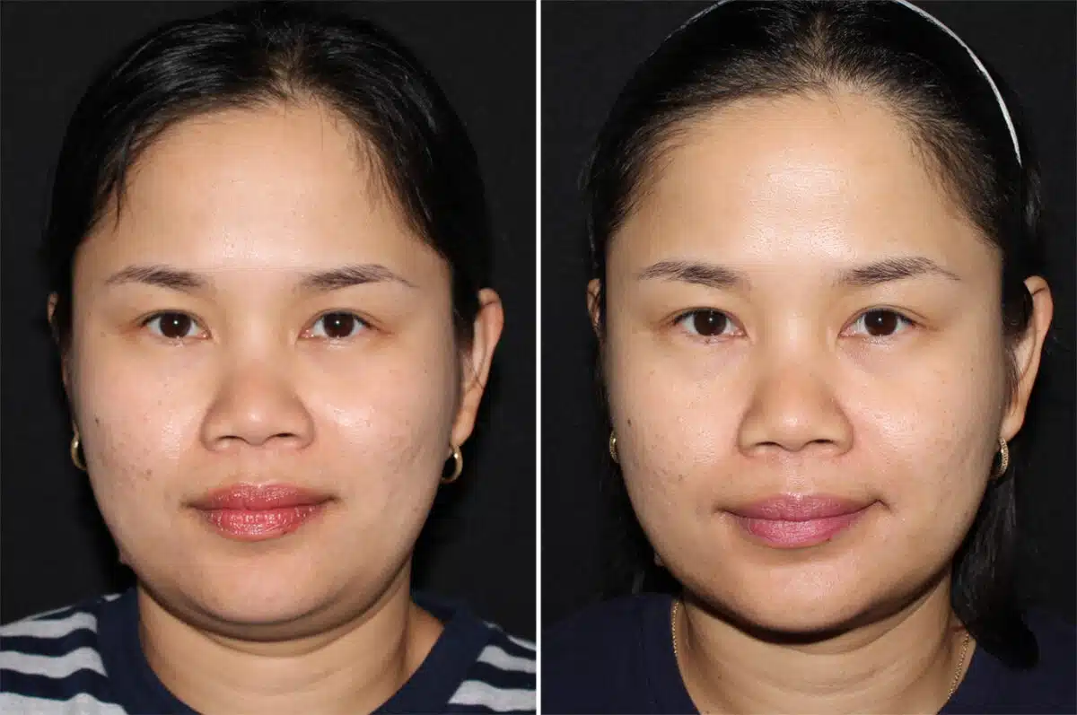 Double Chin Lipo Before and After Photos in CA, Irvine, Patient 2858