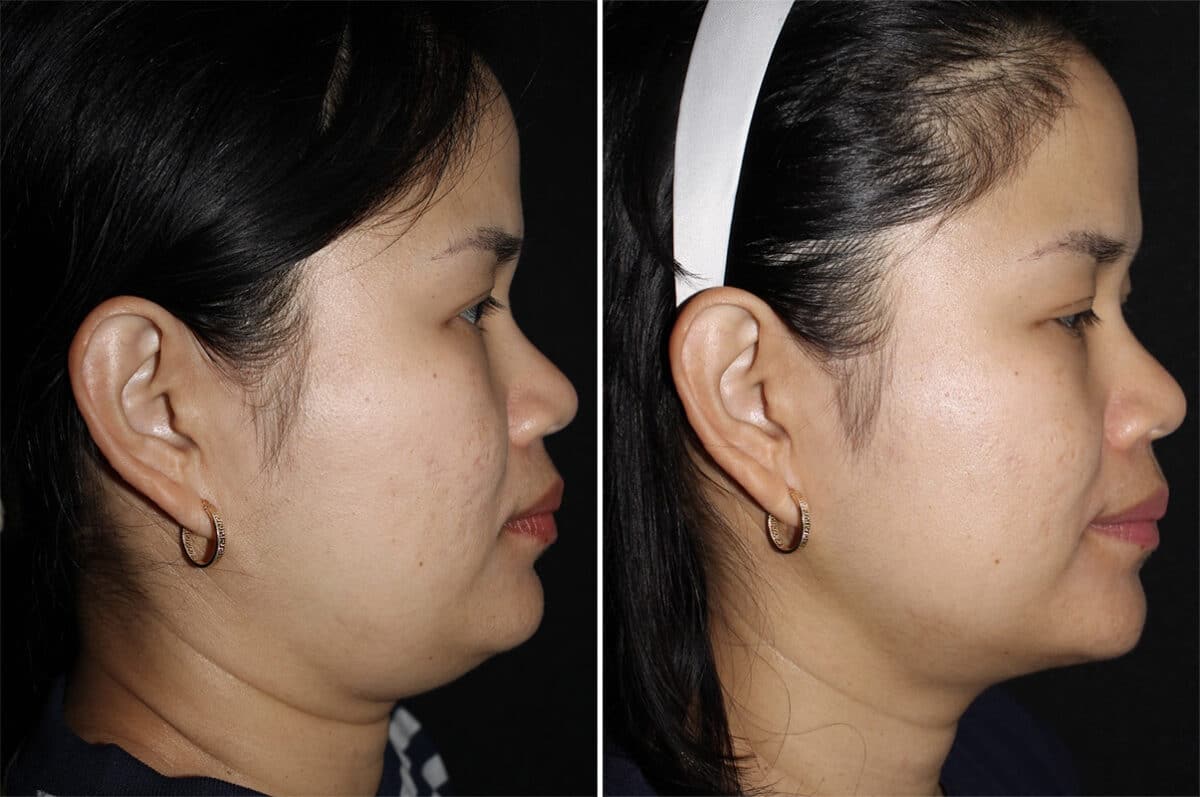 Double Chin Lipo Before and After Photos in CA, Irvine, Patient 2858
