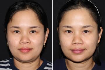 Double Chin Lipo Before and After Photos in CA, Irvine, Patient 2858