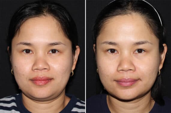 Double Chin Lipo Before and After Photos in CA, Irvine, Patient 2858