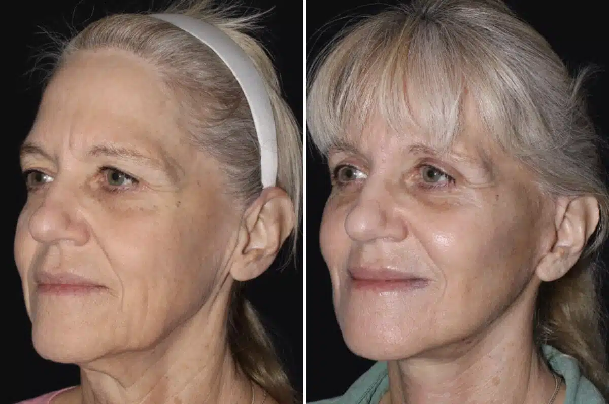Facelift & Necklift Before and After Photos in CA, Irvine, Patient 3540