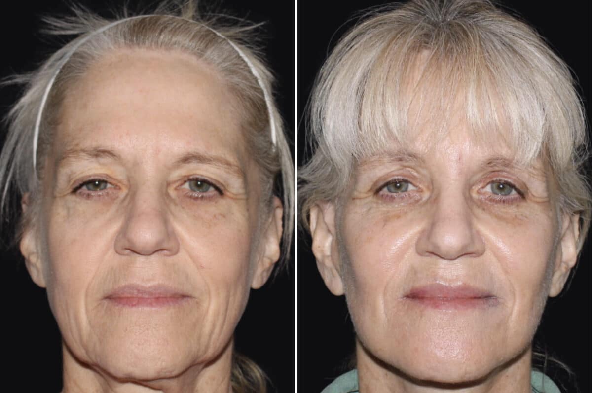 Facelift & Necklift Before and After Photos in CA, Irvine, Patient 3540