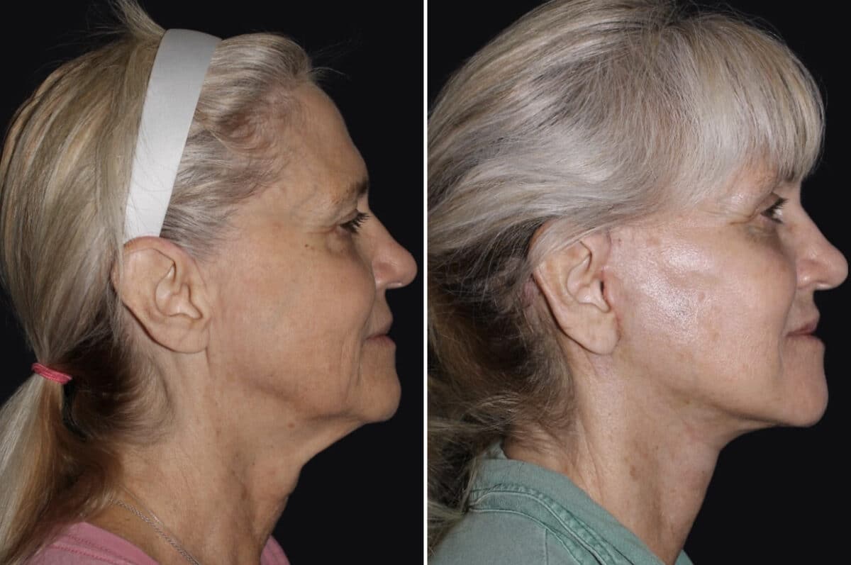 Facelift & Necklift Before and After Photos in CA, Irvine, Patient 3540