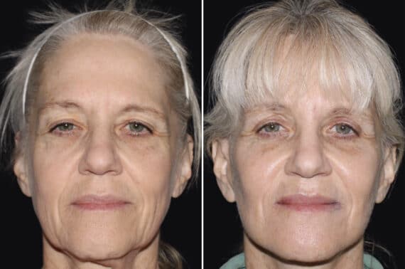 Facelift & Necklift Before and After Photos in CA, Irvine, Patient 3540