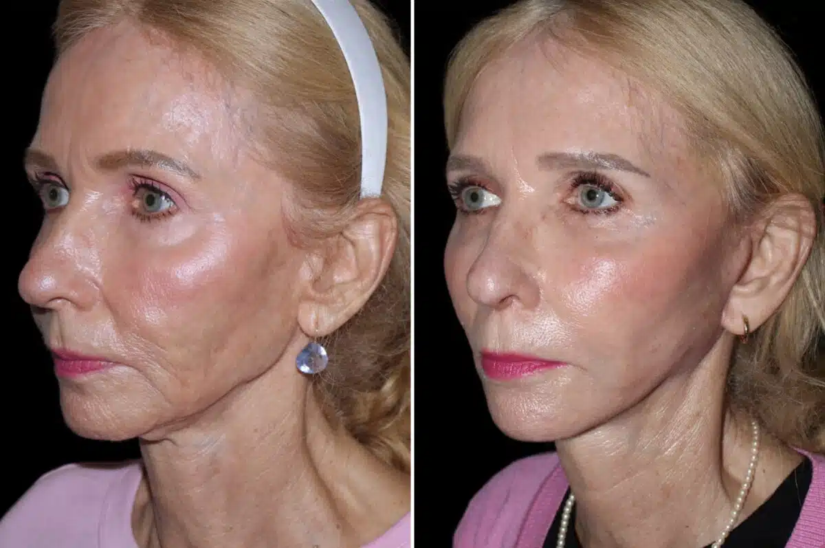 Mini Lift Before and After Photos in CA, Irvine, Patient 3564