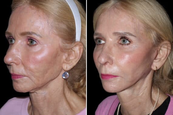 Mini Lift Before and After Photos in CA, Irvine, Patient 3564