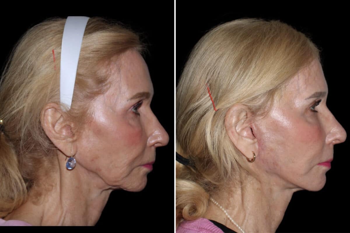 Mini Lift Before and After Photos in CA, Irvine, Patient 3564