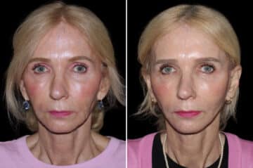Mini Lift Before and After Photos in CA, Irvine, Patient 3564