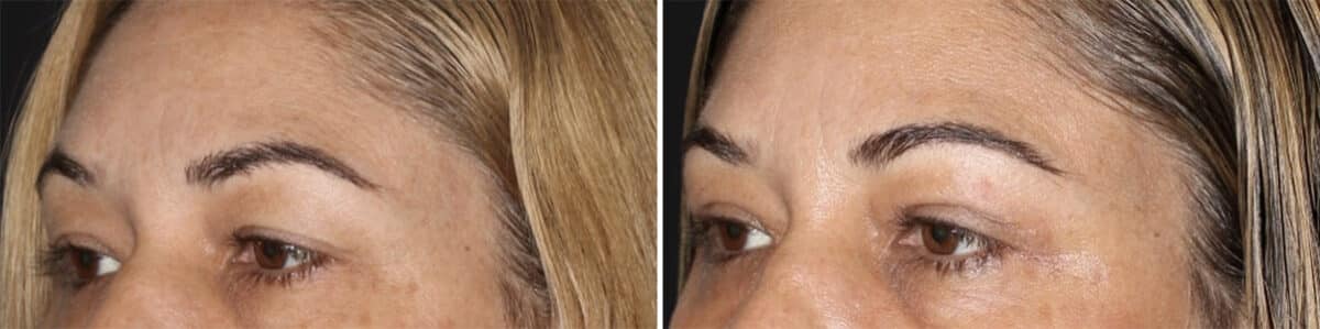 Blepharoplasty Before and After Photos in CA, Irvine, Patient 3568