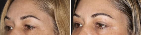 Blepharoplasty Before and After Photos in CA, Irvine, Patient 3568