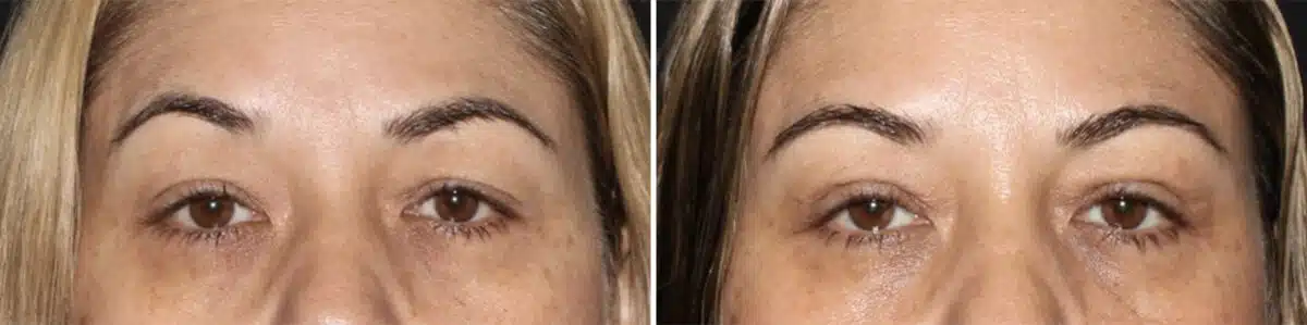 Blepharoplasty Before and After Photos in CA, Irvine, Patient 3568