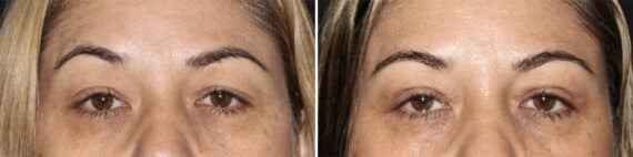Blepharoplasty Before and After Photos in CA, Irvine, Patient 3568