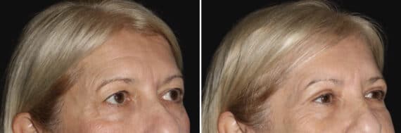 Blepharoplasty Before and After Photos in CA, Irvine, Patient 3571