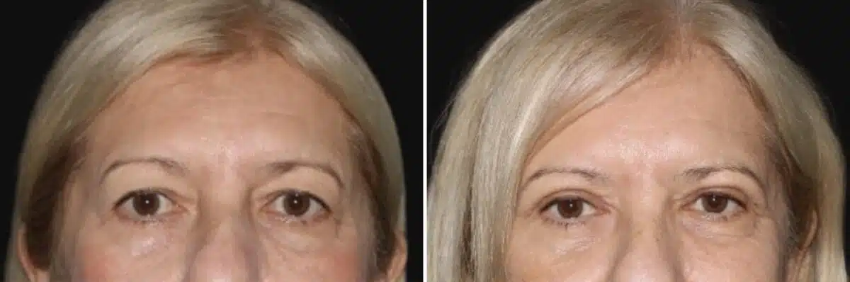 Blepharoplasty Before and After Photos in CA, Irvine, Patient 3571