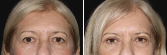 Blepharoplasty Before and After Photos in CA, Irvine, Patient 3571