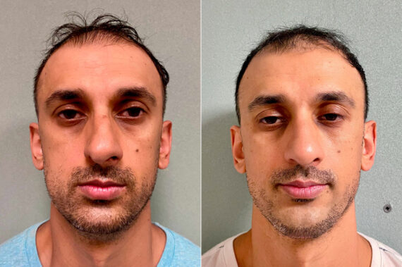 Chin Augmentation Before and After Photos in CA, Irvine, Patient 202