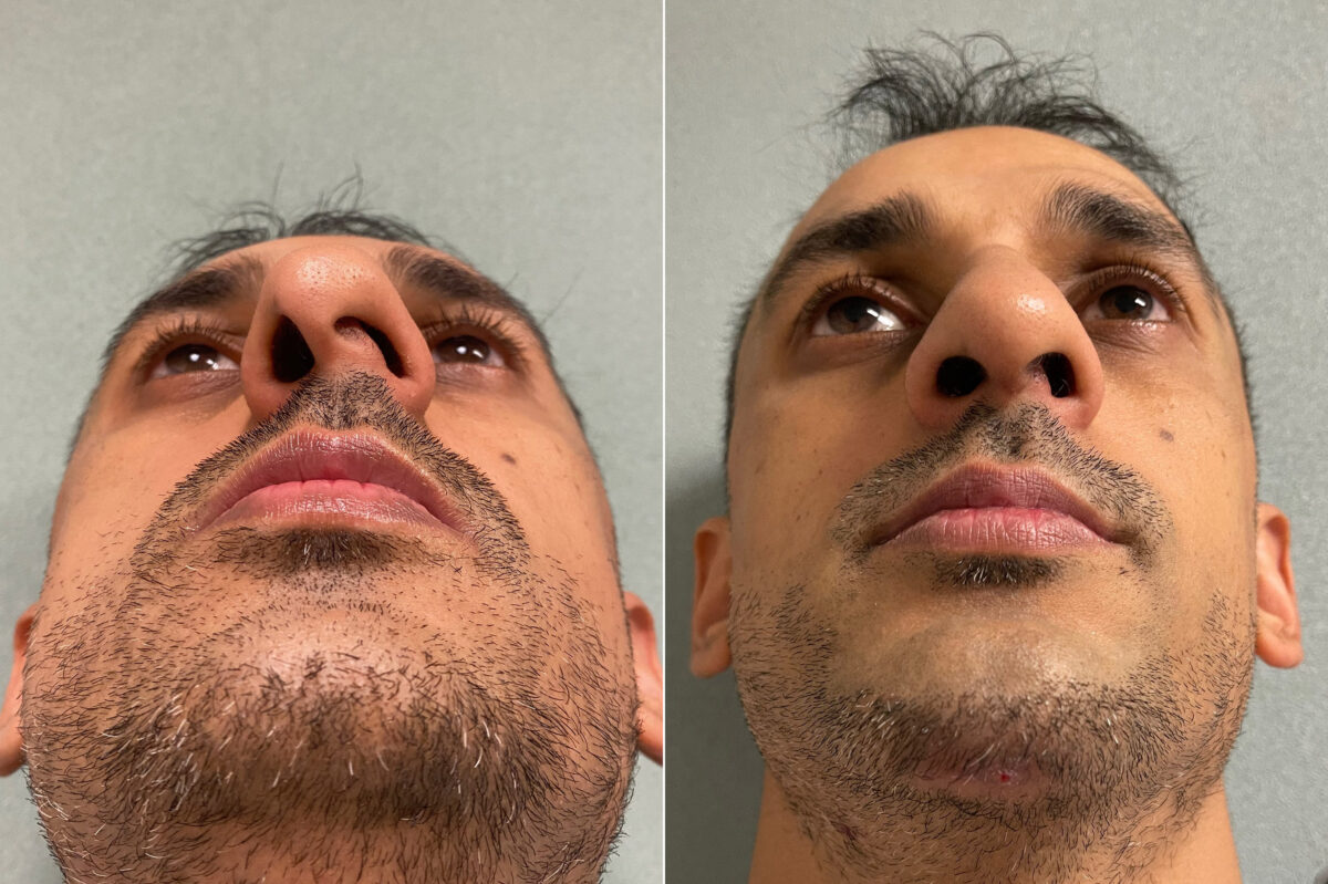 Patient 202, Chin Augmentation Before and After Photos Chin Augmentation Before and After Photos in CA, Irvine, Patient 202