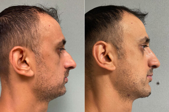Chin Augmentation Before and After Photos in CA, Irvine, Patient 202