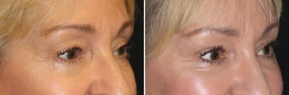 Blepharoplasty Before and After Photos in CA, Irvine, Patient 2100