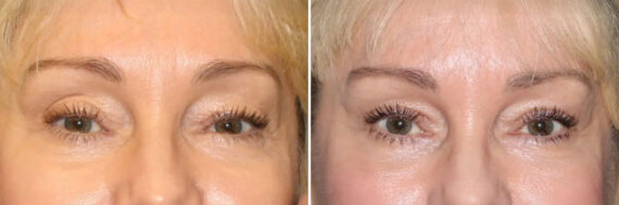 Blepharoplasty Before and After Photos in CA, Irvine, Patient 2100