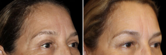Blepharoplasty Before and After Photos in CA, Irvine, Patient 2849