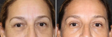 Blepharoplasty Before and After Photos in CA, Irvine, Patient 2849