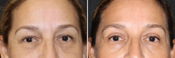 Blepharoplasty Before and After Photos in CA, Irvine, Patient 2849