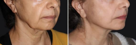 Mini Lift Before and After Photos in CA, Irvine, Patient 3643