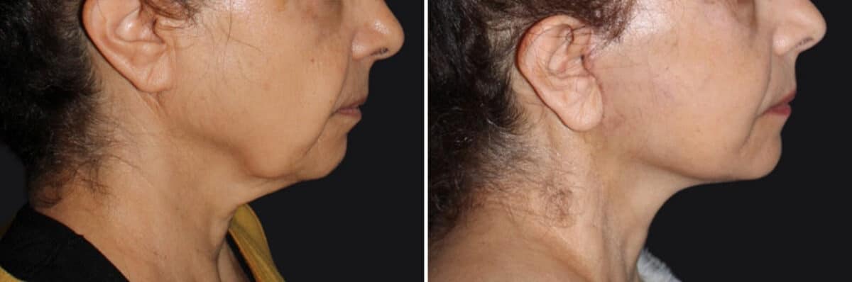 Mini Lift Before and After Photos in CA, Irvine, Patient 3643