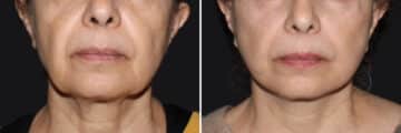 Mini Lift Before and After Photos in CA, Irvine, Patient 3643