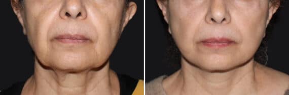 Mini Lift Before and After Photos in CA, Irvine, Patient 3643