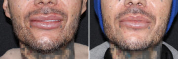 Lip Lift Before and After Photos in CA, Irvine, Patient 3660