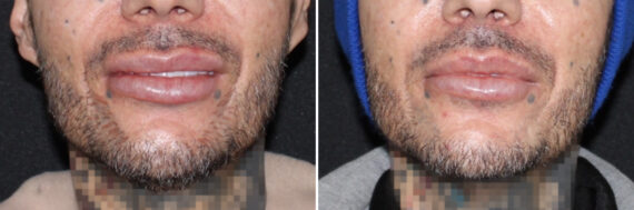 Lip Lift Before and After Photos in CA, Irvine, Patient 3660
