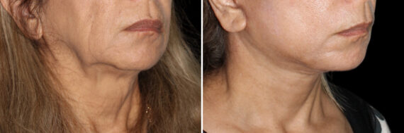 Facelift & Necklift Before and After Photos in CA, Irvine, Patient 3674