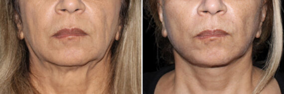 Facelift & Necklift Before and After Photos in CA, Irvine, Patient 3674