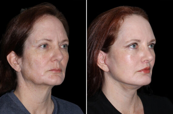 Facelift & Necklift Before and After Photos in CA, Irvine, Patient 3684