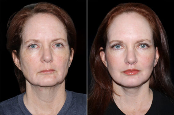 Facelift & Necklift Before and After Photos in CA, Irvine, Patient 3684