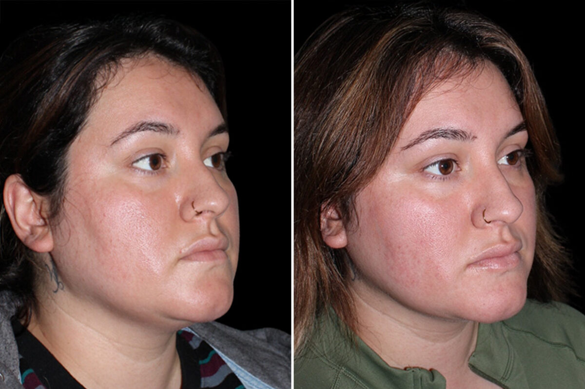 Double Chin Lipo Before and After Photos in CA, Irvine, Patient 3704